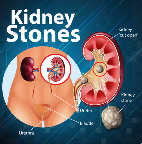 ಕಿಡ್ನಿ ಸ್ಟೋನ್ causes and solutios