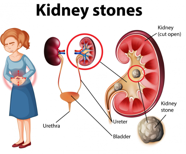 pain during ಕಿಡ್ನಿ ಸ್ಟೋನ್