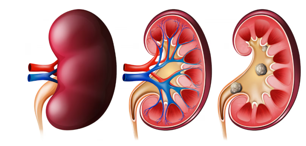 ಕಿಡ್ನಿ ಸ್ಟೋನ್ problem and solutions