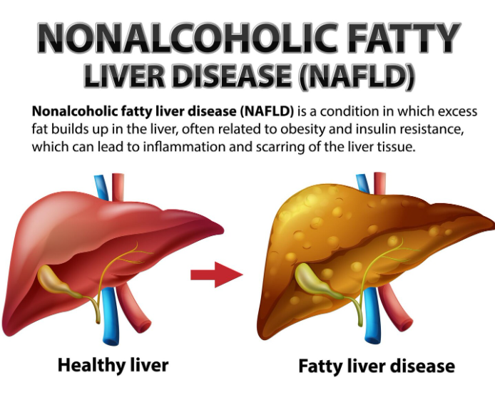 Non halcoholic fatty liver disease
