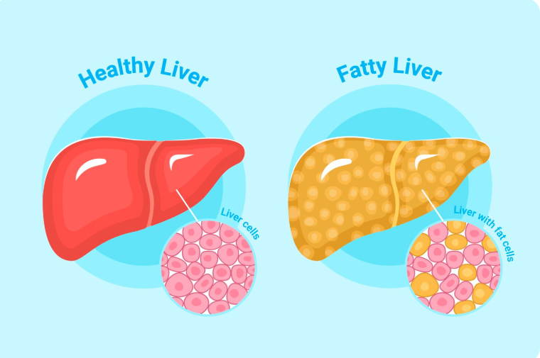 Fatty liver reasons