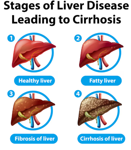 Fatty liver reasons