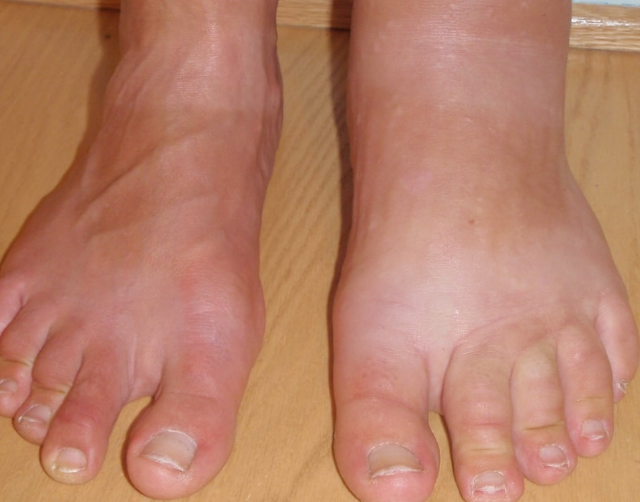 ಉಪ್ಪು sevaneyinda edema kaayile