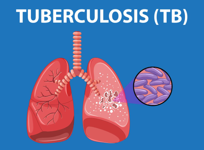 Tuberculosis