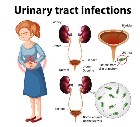ಯೂರಿನ್ ಇನ್ಫೆಕ್ಷನ್