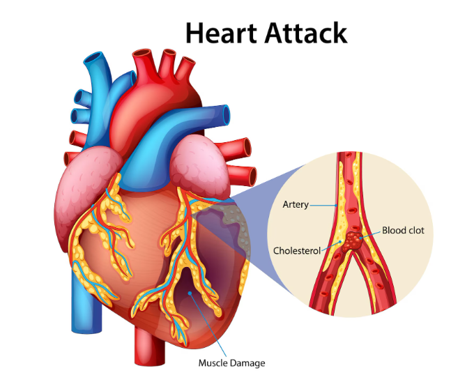 Heart attack ಹಾರ್ಟ್ ಅಟ್ಯಾಕ್