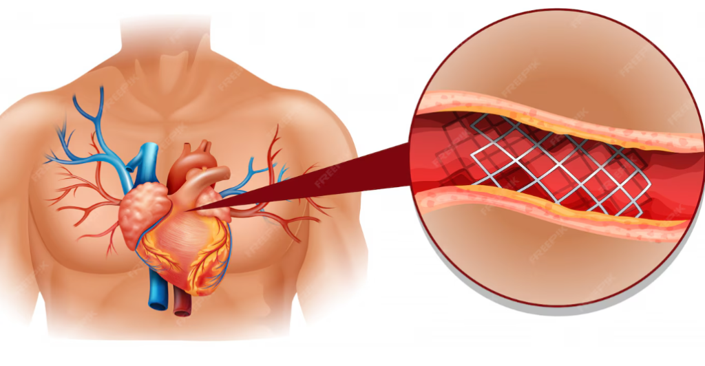 ಆಂಜಿಯೋಪ್ಲ್ಯಾಸ್ಟಿ ಹಾರ್ಟ್ ಅಟ್ಯಾಕ್