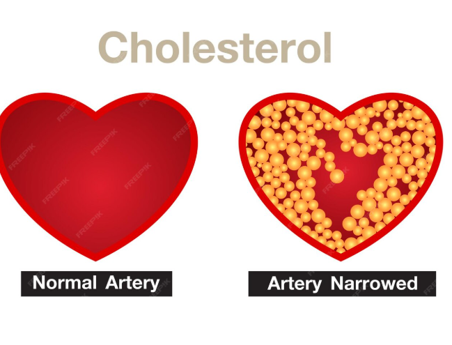 Cholesterol Levels