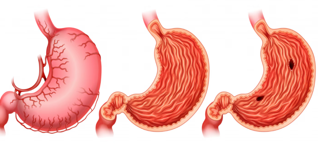 Gastric Problem