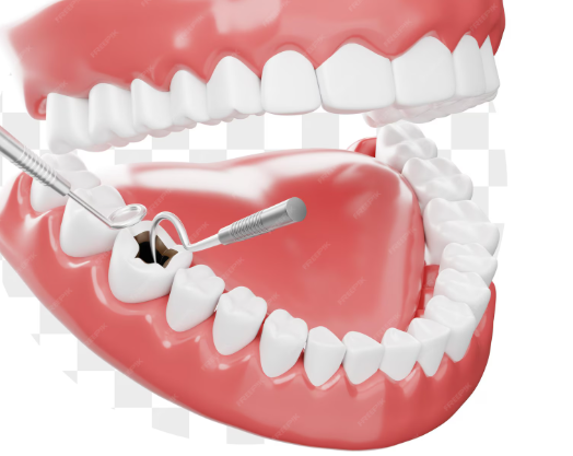 Cavity (Tooth Decay) Problem