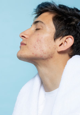 Pimples