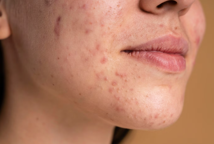 Pimples