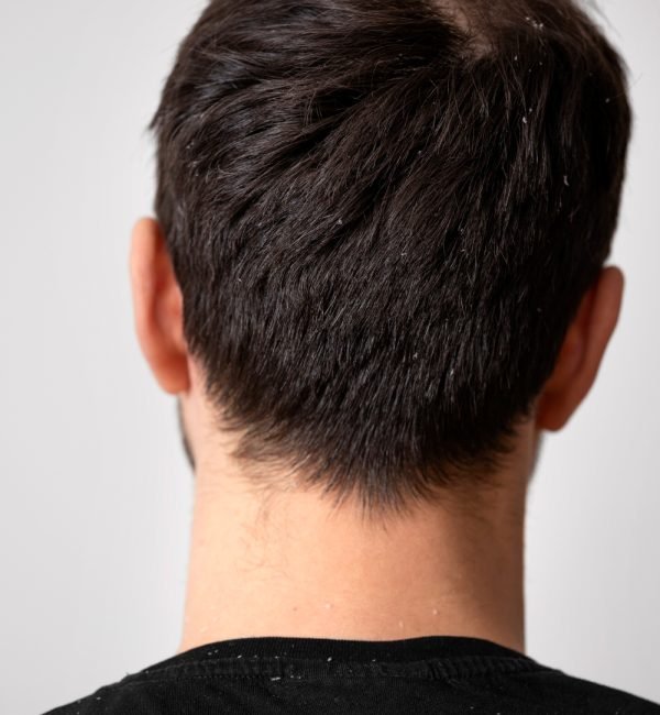 Dandruff Problem